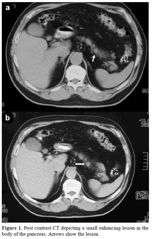 pancreas-Post-contrast-CT-depicting