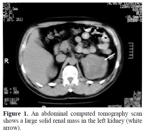 A Case Of A Solid Renal Mass Together With A Cystic Pancreatic Lesion In A 50 Year Old Patient Insight Medical Publishing