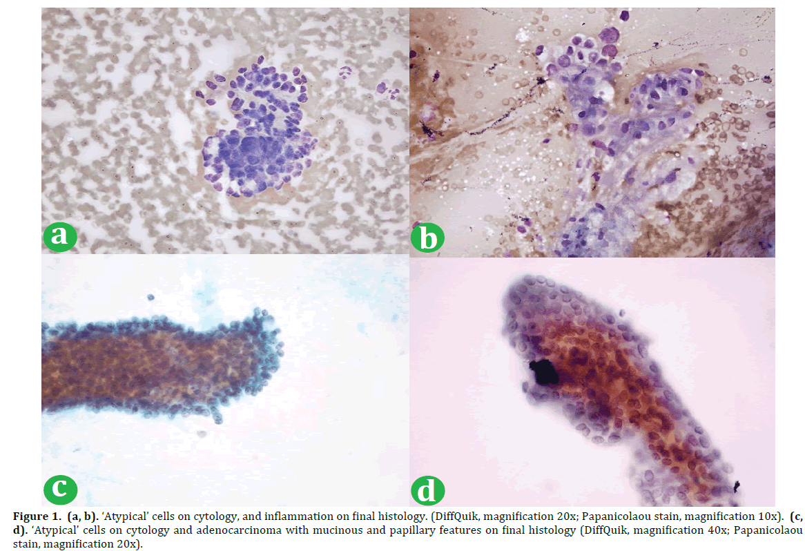 atypical-urothelial-cells-auc-basicmedical-key