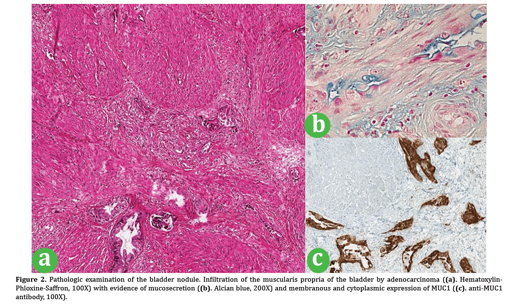 Bladder Metastasis From Pancreatic Ductal Adenocarcinoma Case Report And Comprehensive Literature Review Insight Medical Publishing