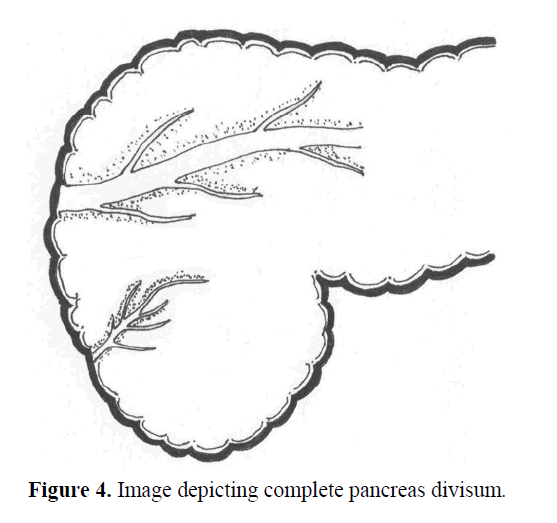 Ansa Pancreatica Type of Ductal Anatomy in a Patient with Idiopathic