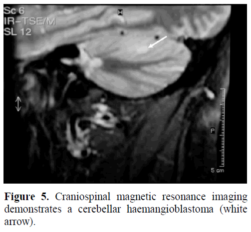 A Case Of A Solid Renal Mass Together With A Cystic Pancreatic Lesion In A 50 Year Old Patient Insight Medical Publishing