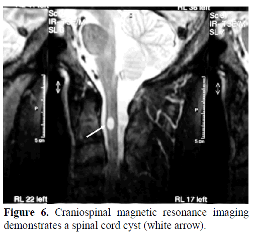 A Case Of A Solid Renal Mass Together With A Cystic Pancreatic Lesion In A 50 Year Old Patient Insight Medical Publishing