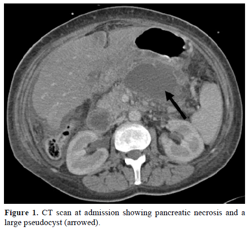 Pancreaticobronchial Fistula A Complication Of Acute Pancreatitis Insight Medical Publishing