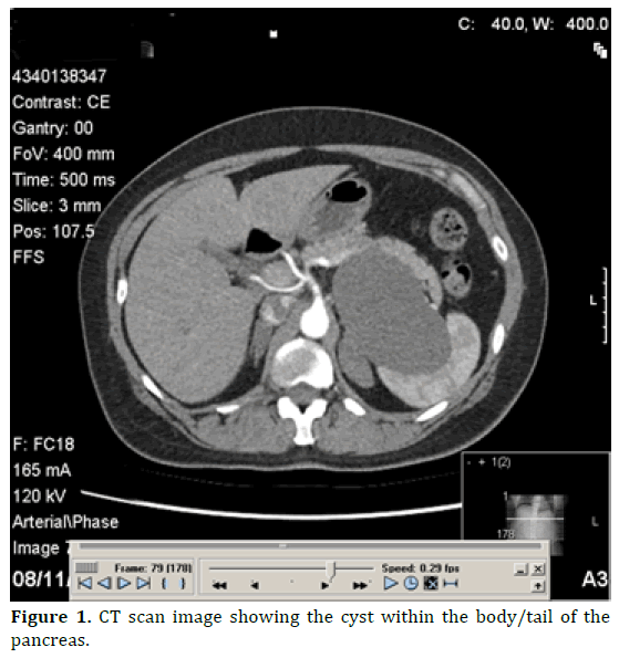 ciliated-foregut-cyst-of-the-pancreas-another-differential-in-the