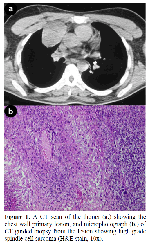cpt code soft tissue mass chest wall cpt code soft tissue mass chest wall