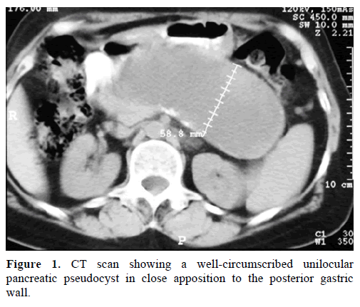 Recurrent Pancreatic Pseudocyst Diagnosed 9 Years After Initial Surgical Drainage Insight Medical Publishing