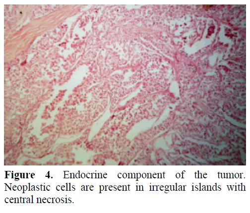 Mixed Exocrine Endocrine Tumor Of The Pancreas Insight Medical Publishing