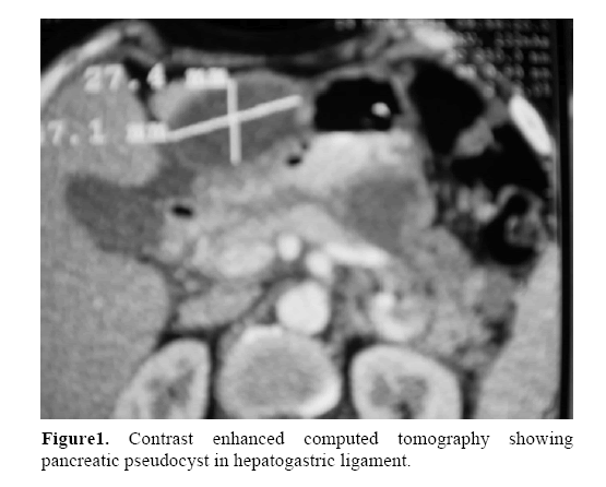 Pancreatic Pseudocyst Of Gastrohepatic Ligament A Case Report And Review Of Management Insight Medical Publishing