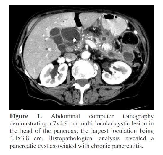 Pancreas Multi Locular Cystic Lesion Pancreas Multi Locular Cystic Lesion