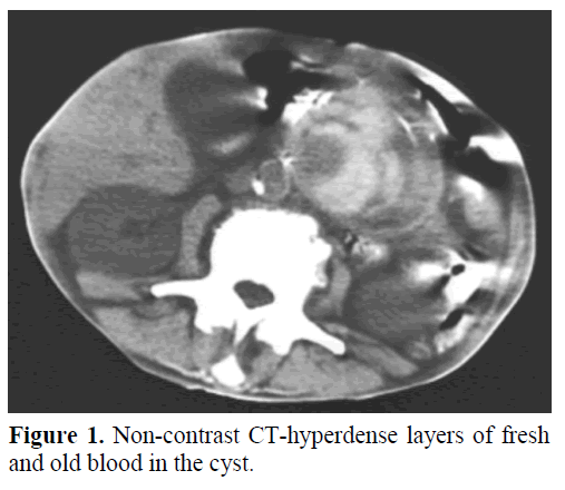 Embolization Of A Large Pancreatic Pseudoaneurysm Converted From Pseudocyst Hemorrhagic Pseudocyst Insight Medical Publishing