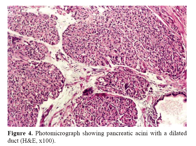 Heterotopic Pancreas in the Stomach: A Case Report and a Brief Review