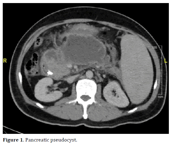 Metal Stents In Management Of Pancreatic Pseudocyst And Walled Off Necrosis Insight Medical Publishing