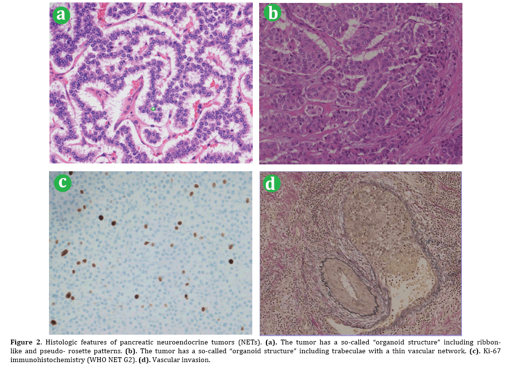 Neuroendocrine Neoplasms Of The Pancreas The Pathological Viewpoint Insight Medical Publishing