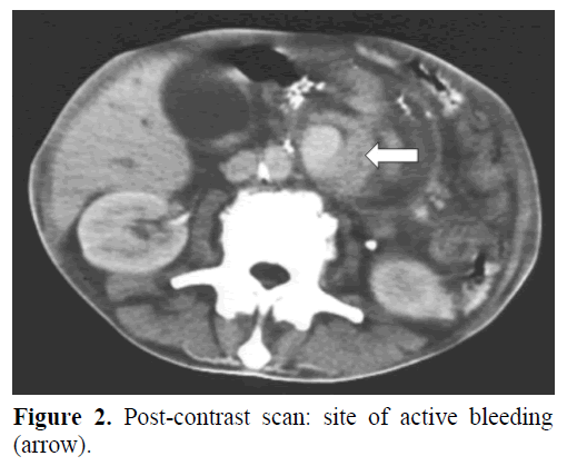 Embolization Of A Large Pancreatic Pseudoaneurysm Converted From Pseudocyst Hemorrhagic Pseudocyst Insight Medical Publishing