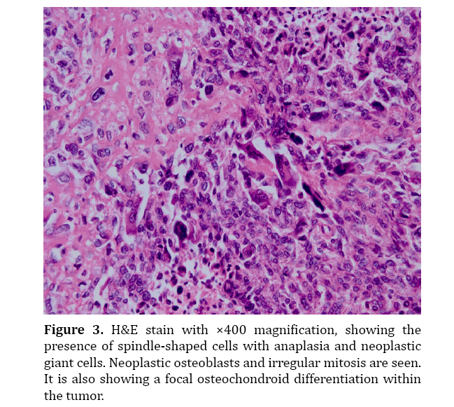 Undifferentiated Spindle Cell Pancreatic Carcinoma A Case Report With Osteochondroid Differentiation Insight Medical Publishing