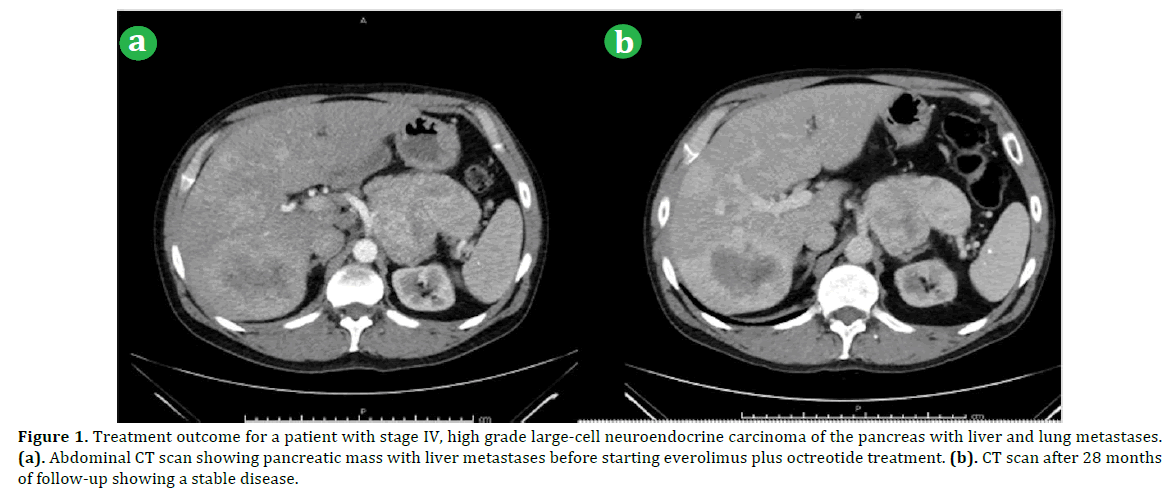 Everolimus And Octreotide In A Patient With High Grade Pancreatic Neuroendocrine Carcinoma Insight Medical Publishing